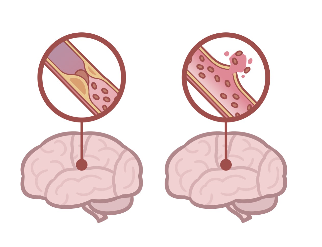 脳 梗塞 と 脳卒中 の 違い